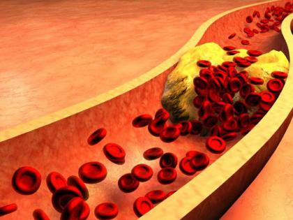 If you are facing problems like Artery blockage and blood clots, then here's the natural home remedies for you