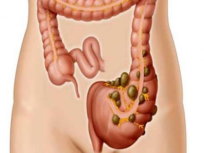 Ulcerative Colitis treatment at home: causes, signs and symptoms, home remedies, healthy diet plan, Ayurveda remedies for Colitis in Hindi | कोलाइटिस का आयुर्वेदिक उपचार : पेट की दर्दनाक बीमारी आंत की सूजन Colitis से छुटकारा पाने के 8 घरेलू उपचार Ulcerative Colitis treatment at home: causes, signs and symptoms, home remedies, healthy diet plan, Ayurveda remedies for Colitis in Hindi | कोलाइटिस का आयुर्वेदिक उपचार : पेट की दर्दनाक बीमारी आंत की सूजन Colitis से छुटकारा पाने के 8 घरेलू उपचार