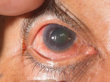 Good News: Blindness decreased by 47 percent, number was 1.2 crore in 2006-07, which reduced to only 48 lakh in 2019 | गुड न्यूजः अंधेपन में 47 प्रतिशत की कमी, 2006-07 में संख्या 1.2 करोड़ थी, जो 2019 में घटकर मात्र 48 लाख Good News: Blindness decreased by 47 percent, number was 1.2 crore in 2006-07, which reduced to only 48 lakh in 2019 | गुड न्यूजः अंधेपन में 47 प्रतिशत की कमी, 2006-07 में संख्या 1.2 करोड़ थी, जो 2019 में घटकर मात्र 48 लाख