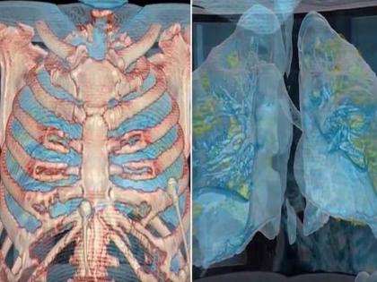 Coronavirus treatment: Covid-19 effect your lungs, searcher claim, Nitrate Supplementation could help in breathing and lung clearance | COVID-19 treatment: फेफड़ों को संक्रमित करता है कोरोना, फेफड़ों को साफ करके सांस लेने में सुधार करता है नाइट्रेट सप्लीमेंट