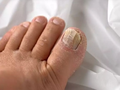 post-COVID symptoms in Hindi: COVID nails symptoms you can find on hand and feet nails of recovered covid patients | COVID nails symptoms: ठीक हुए मरीजों के नाखूनों में दिख रहा है यह गंभीर लक्षण, समझें और जांच कराएं