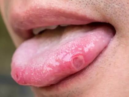 COVID Tongue symptoms in Hindi: What is COVID tongue and what are its symptoms in Hindi | COVID Tongue symptoms: जीभ पर दिखाई देता है कोरोना का यह अजीब लक्षण, इन 5 संकेतों से समझें और टेस्ट कराएं