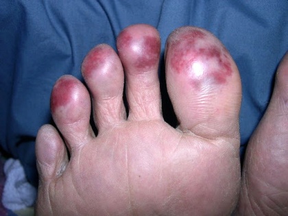 Early signs and symptoms of coronavirus or covid-19: researcher found foot sores new symptoms in corona patients | Coronavirus Symptoms: पैरों की उंगलियों, तलवों या पैर के ऊपर बैंगनी रंग के घाव हो सकते हैं कोरोना के लक्षण, तुरंत जाएं डॉक्टर के पास