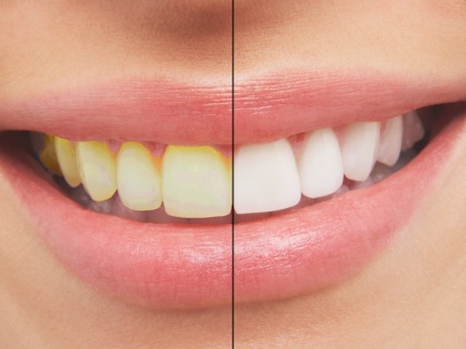 tips to whiten yellow teeth | पीले दांतों को सफेद करने के 3 तरीके