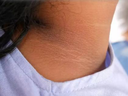 Diabetes early symptoms: early warning signs and symptoms of Type-2 diabetes in Hindi | Diabetes early symptoms: आपको हो चुकी है डायबिटीज की बीमारी, इन 6 लक्षणों से करें पहचान Diabetes early symptoms: early warning signs and symptoms of Type-2 diabetes in Hindi | Diabetes early symptoms: आपको हो चुकी है डायबिटीज की बीमारी, इन 6 लक्षणों से करें पहचान