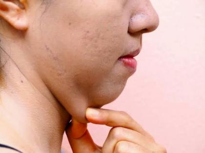 Get Rid Double Chin by Home Remedies.