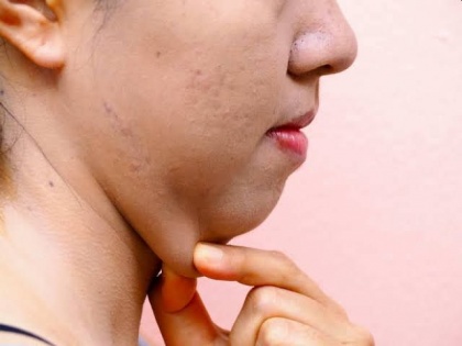 How to Get Rid of a Double Chin: double chin treatment, tips and home remedies to get rid double chin in Hindi, chehre ka motapa kaise kam karen | चेहरे का मोटापा कैसे कम करें : चेहरे की चर्बी खत्म करके गालों को पतला करने के 8 घरेलू उपाय