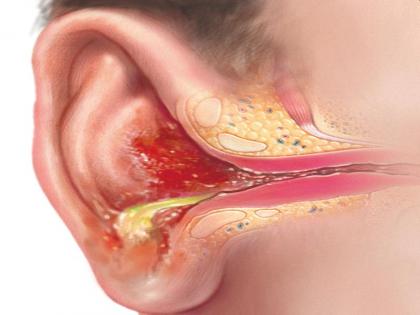 how to get rid ear pain or Earache: 5 best and effective home remedies to treat how to ear pain or Earache, ear infection naturally in Hindi | कान के दर्द का रामबाण इलाज : इन्फेक्शन के कारण कान में होने दर्द से राहत पाने के 5 असरदार घरेलू उपाय