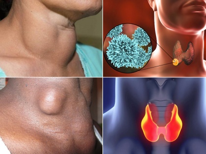 early signs and symptoms of Thyroid Cancer, causes, risk factors, medical treatment, home remedies, foods to eat and avoid for thyroid in Hindi | सावधान! थायराइड कैंसर होने से पहले शरीर देता है 15 चेतावनी, लड़कियों में ज्यादा दिखते हैं 5 लक्षण