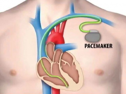pacemakers that can be powered by heartbeats, know what is a pacemaker and how do work | अब दिल की धड़कनों से ही चलेंगे पेसमेकर, जानिये ये इलेक्ट्रिक डिवाइस कैसे बचा सकता है जान