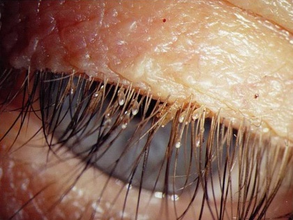 eyelash lice treatment : causes and symptoms of eyelash and pubic lice, prevention and home remedies for eyelash and pubic lice | आंखों में तेज खुजली, जलन, लालीपन का कारण बनती हैं पलकों की जूं, जानें कारण, लक्षण, बचने के उपाय