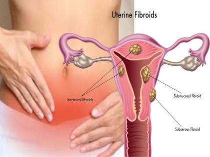 fibroids causes and symptoms, treatment, prevention, risk factors, medical Ayurveda treatment, home and natural remedies in hindi | रसौली कितनी ही बड़ी क्यों न हो बिना तकलीफ बाहर निकाल सकती है ये जादुई जड़ी-बूटी, ऐसे करें यूज