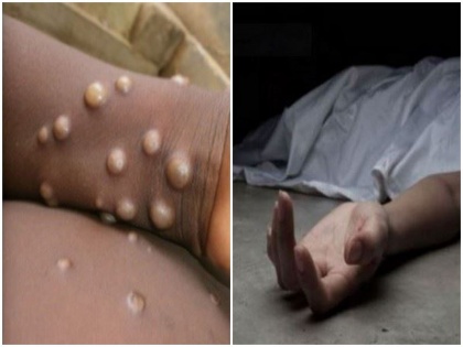 first case of monkeypox seen America local health officials confirmed the death cds silent | USA Monkeypox Updates: अमेरिका में मंकीपॉक्स से हुई पहली मौत, स्थानीय स्वास्थ्य अधिकारियों द्वारा की गई पुष्टी