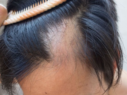 hair care tips : 4 easy ways to fight hair fall, split ends, dandruff, hair growth problem using aloe vera | डैंड्रफ-बाल झड़ने की समस्या को खत्म करके, सफेद, कमजोर, दो मुंहे बालों में जान फूंक देगा 3 मिनट का ये उपाय