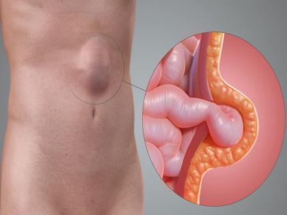 hernia treatment without surgery : follow these home or natural remedies to get rid hernia | हर्निया में नहीं पड़ेगी सर्जरी की जरूरत, बस कुछ दिन करें ये 5 काम, दर्द से भी मिलेगा छुटकारा hernia treatment without surgery : follow these home or natural remedies to get rid hernia | हर्निया में नहीं पड़ेगी सर्जरी की जरूरत, बस कुछ दिन करें ये 5 काम, दर्द से भी मिलेगा छुटकारा