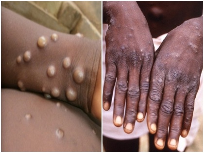 Health News Monkeypox can become an endemic disease here's how it can be controlled usa europe africa | Health News: मंकीपॉक्स बन सकता है स्थानिक रोग, यहां जानिए कैसे लगाई जा सकती है इसपर लगाम