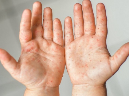 HFMD Hand, Foot and Mouth Disease 26 children sick conditionstable what are symptoms odisha | HFMD: एचएफएमडी बीमारी से 26 बच्चे बीमार, सभी की हालत स्थिर, जानें इस रोग के बारे में, क्या है लक्षण