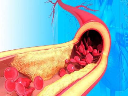 how to get rid cholesterol: cholesterol diet plan, foods that can lower cholesterol level, how to reduce cholesterol level naturally in Hindi | Cholesterol diet plan: शरीर में कोलेस्ट्रॉल कम करके हार्ट अटैक और स्ट्रोक से बचा सकती हैं ये 6 सब्जियां