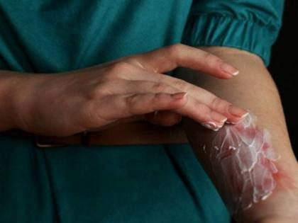 Home Remedies for burns, check out first aid treatment