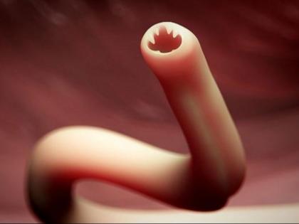 Hookworms drain 22 litres of blood from 14-yr-old for over two years | कीड़ों ने चूस लिया 14 साल के किशोर का 22 लीटर खून, वायरलैस कैमरा कैप्सूल से खुला राज