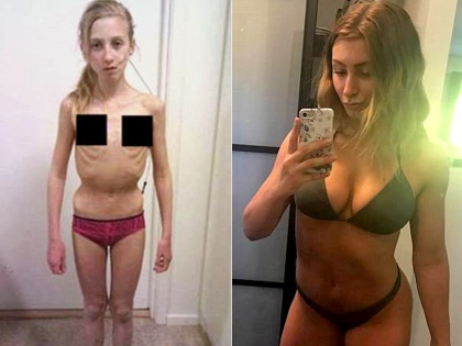 Girl Suffering from Anorexia sets example by making hot and sexy body | एनोरेक्सिया से पीड़ित इस दुबली-पतली लड़की ने ऐसे बनाया हॉट एंड सेक्सी फिगर