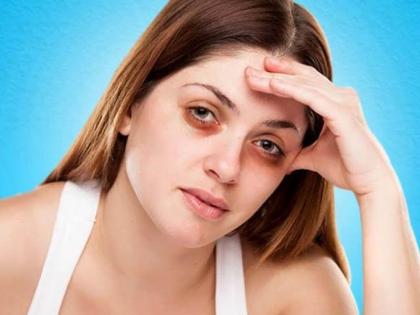 5 main reason of dark circles, you should be aware, know natural Home remedies to remove dark circles in Hindi | इन वजहों से होते है डार्क सर्कल, अपनाएं ये 7 घरेलू नुस्खें, नहीं होगी महंगे क्रीम की जरूरत 5 main reason of dark circles, you should be aware, know natural Home remedies to remove dark circles in Hindi | इन वजहों से होते है डार्क सर्कल, अपनाएं ये 7 घरेलू नुस्खें, नहीं होगी महंगे क्रीम की जरूरत
