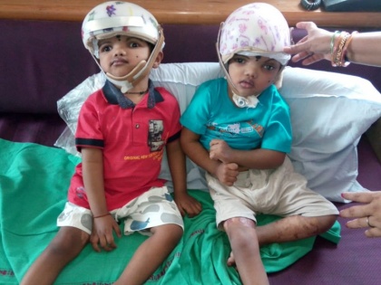 Odisha twins Jaga and Balia linked with head get successful surgery, now they will return home | सिर से जुड़े हुए थे जुड़वां बच्चे, एम्स के डॉक्टरों ने किया कमाल, अब लौट सकेंगे घर