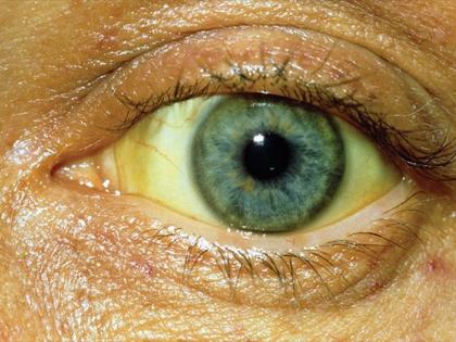 Home remedies for jaundice