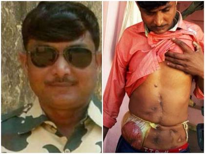 Madhya pradesh CRPF jawan is compelled to live with keeping intestine in polythene | नक्सली हमले में मौत के मुंह से बाहर आया था जवान, 4 साल से पॉलीथीन में आंत रख कर भटकने को मजबूर Madhya pradesh CRPF jawan is compelled to live with keeping intestine in polythene | नक्सली हमले में मौत के मुंह से बाहर आया था जवान, 4 साल से पॉलीथीन में आंत रख कर भटकने को मजबूर