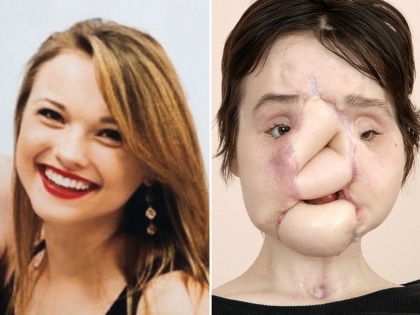 Katie Stubblefield becomes the youngest person ever to receive a face transplant | इस खूबसूरत लड़की ने चेहरे पर मार ली थी गोली, फेस सर्जरी से मिली नई जिंदगी