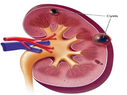 how to get rid Kidney Cysts: Symptoms and Causes Diagnosis and Tests Management and Treatment Prevention of Kidney Cysts in Hindi | किडनी की गांठ का इलाज : किडनी में गांठ होने पर मिलते हैं 6 संकेत, समझें और डॉक्टर के पास जाएं
