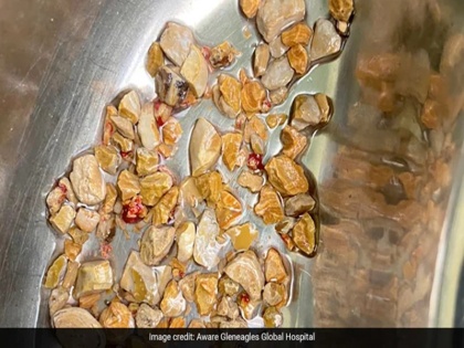 Hyderabad 206 Kidney Stones Removed In 1 Hour From 56-Year-Old Man | हैदराबादः 56 वर्षीय बुजुर्ग की किडनी में से 1 घंटे में निकाले गए 206 स्टोन, 6 महीने से असहनीय दर्द से गुजर रहा था मरीज