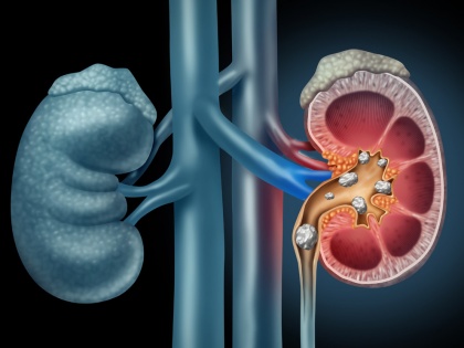 World Kidney Day : causes of kidney stone and home remedies or food to flush kidney stones naturally | World Kidney Day : धीरे-धीरे दोनों किडनियों में पथरी बना देते हैं रोजाना के ये 5 काम, ये 5 चीजें करेंगी बाहर
