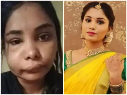 Kannada actress Swati Satish swollen face after root canal surgery difficult to recognize pictures surfaced | रूट कैनाल सर्जरी के बाद अभिनेत्री का सूजा चेहरा, पहचानना हुआ मुश्किल, सामने आई तस्वीरें