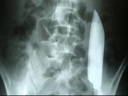 Knife Found In Abdomen Of Man Suffering From Pain | दर्द से जूझ रहे शख्स के पेट में मिला 15 सेमी लंबा चाकू, जानिए हैरान कर देने वाला पूरा मामला Knife Found In Abdomen Of Man Suffering From Pain | दर्द से जूझ रहे शख्स के पेट में मिला 15 सेमी लंबा चाकू, जानिए हैरान कर देने वाला पूरा मामला