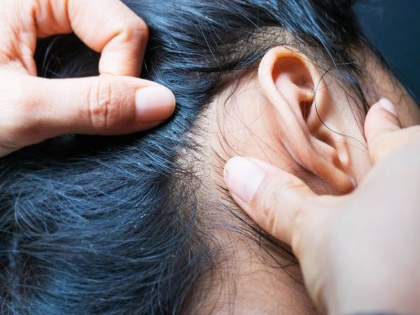 try and tested home remedy for lice | बालों की जूं से 1 दिन में छुटकारा पाने का आसान घरेलू उपाय