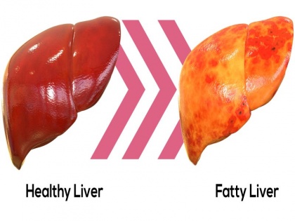 fatty liver treatment: fatty liver causes, symptoms, how to reduce fatty liver, home remedies and foods for fatty liver in Hindi | फैटी लिवर का आयुर्वेदिक इलाज : लिवर की चर्बी खत्म करने और सफाई के लिए 4 आसान घरेलू उपाय