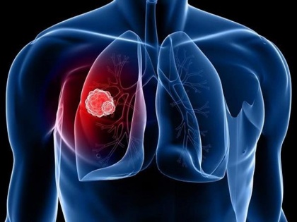 health advice cough common symptoms of lung cancer alert for smokers | Lung Cancer: लंबे समय से खांसी (Cough) आना हो सकता है लंग कैंसर का लक्षण, धूम्रपान करने वालों को चेतावनी
