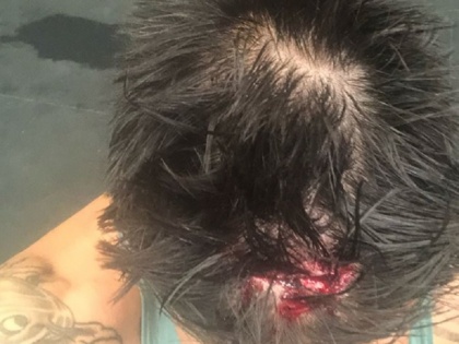 mitchell johnson head injury during gym session photos shared on instagram | जिम करते हुए मिचेल जॉनसन के सिर में लगी चोट, लगाने पड़े 16 टांके