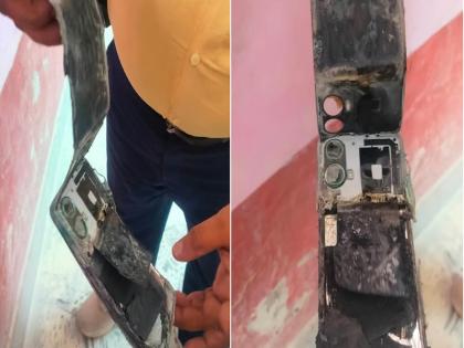 UP: Mobile exploded in the pocket of a patient undergoing treatment in Barabanki hospital | UP: बाराबंकी अस्पताल में इलाज करा रहे मरीज की जेब में मोबाइल फटा