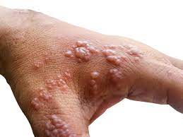 Monkeypox Doctors and scientists worried How Can You Catch What Are Symptoms how does disease spread | Monkeypox: मंकीपॉक्स को लेकर डॉक्टर और वैज्ञानिक चिंतित, क्या हैं लक्षण और कैसे फैलती है यह बीमारी?, यहां जानें