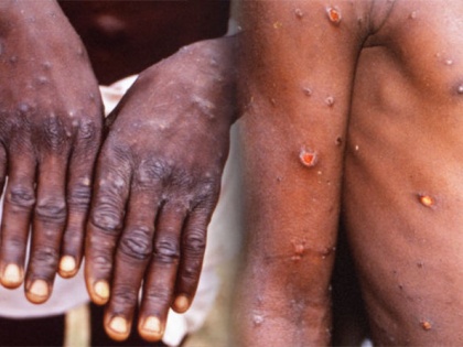 First death due to monkeypox in America, 'cases of death have been reported in 15 countries including Cuba, Brazil, Ecuador, Ghana and Nigeria' | अमेरिका में मंकीपॉक्स से हुई पहली मौत, 'क्यूबा, ​​ब्राजील, इक्वाडोर, घाना और नाइजीरिया समेत 15 देशों में सामने आ चुके हैं मौत के मामले'