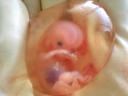 Motihari Bihar doctors surprised find fetus stomach 40-day-old child was developed womb mother viral message | बिहार के मोतिहारी में दिखा कुदरत का करिश्मा, 40 दिन के बच्चे के पेट में भ्रूण मिलने पर डॉक्टर भी हुए हैरान, मां के पेट में ही बच्चे की कोख में हुआ था विकसित