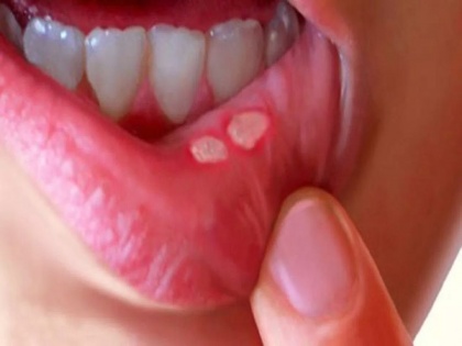 Mouth ulcer treatment at home: home remedies and Ayurveda remedies to treat mouth ulcer, foods and herbs for mouth ulcer in Hindi | मुंह के छाले का आयुर्वेदिक इलाज : मुंह में होने वाले दर्दनाक छालों से दो दिन में छुटकारा पाने के 10 घरेलू उपाय