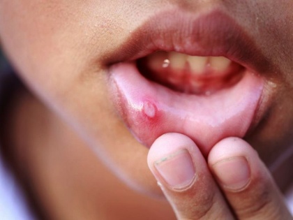 mouth ulcer treatment in hindi: causes, symptoms, risk factors, treatment, home remedies, natural remedies, Ayurveda remedies for mouth ulcer in Hindi | मुंह के दर्दनाक छालों को कुछ ही मिनटों में जड़ से खत्म कर सकती हैं ये 10 चीजें