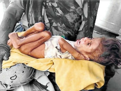 Madhya Pradesh: Highly malnourished 4 year old child found near Bhopal weighing 3 kg | मध्य प्रदेश: राजधानी के पास मिला अति कुपोषित 4 साल का बच्चा, वजन 3 किलो, सरकार बीजेपी पर फोड़ रही ठीकरा