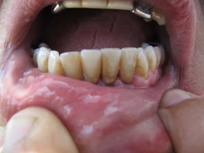 teeth gums problem for years adopt these 5 home remedies today you will get relief fast health tips in hindi dant ka dard | दांत और मसूड़ों की समस्या से बरसों से है परेशान, अब और नहीं आज ही अपनाएं ये 5 घरेलू नुस्खे, चुटकियों में मिलेगी राहत