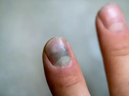 how nails tell about health: How the colour of your nails can reveal about skin cancer Subungual melanoma | नाखून बता सकते हैं आपका स्वास्थ्य, नाखून के बदलते रंग को देखकर ऐसे समझें कहीं आपको कैंसर तो नहीं