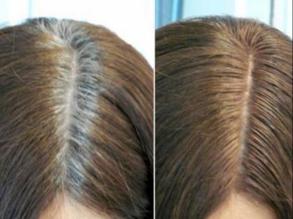 natural ways to make white hair black | तो इसलिए कम उम्र में सफेद हो जाते हैं बाल, इन घरेलू उपचार से करें इन्हें काला