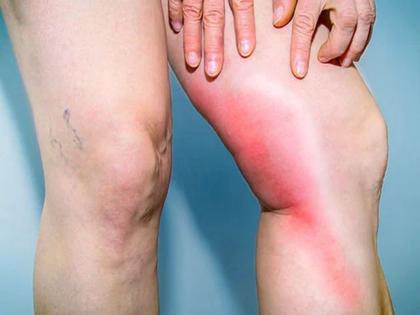 8 best and effective home remedies to get rid of leg vessels and nerves | पैर की नसों के दर्द का घरेलू इलाज : पैर की नसों में खिंचाव और दर्द से राहत पाने के लिए आजमाएं ये 6 घरेलू उपाय